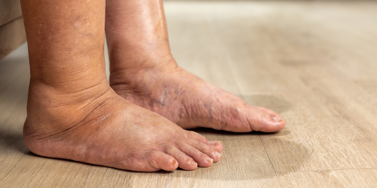 Caviglia e piede gonfio, possibile edema da valutare